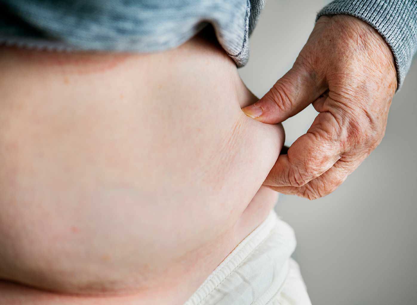“Close-up of a person grasping a fold of abdominal skin with their fingers.”