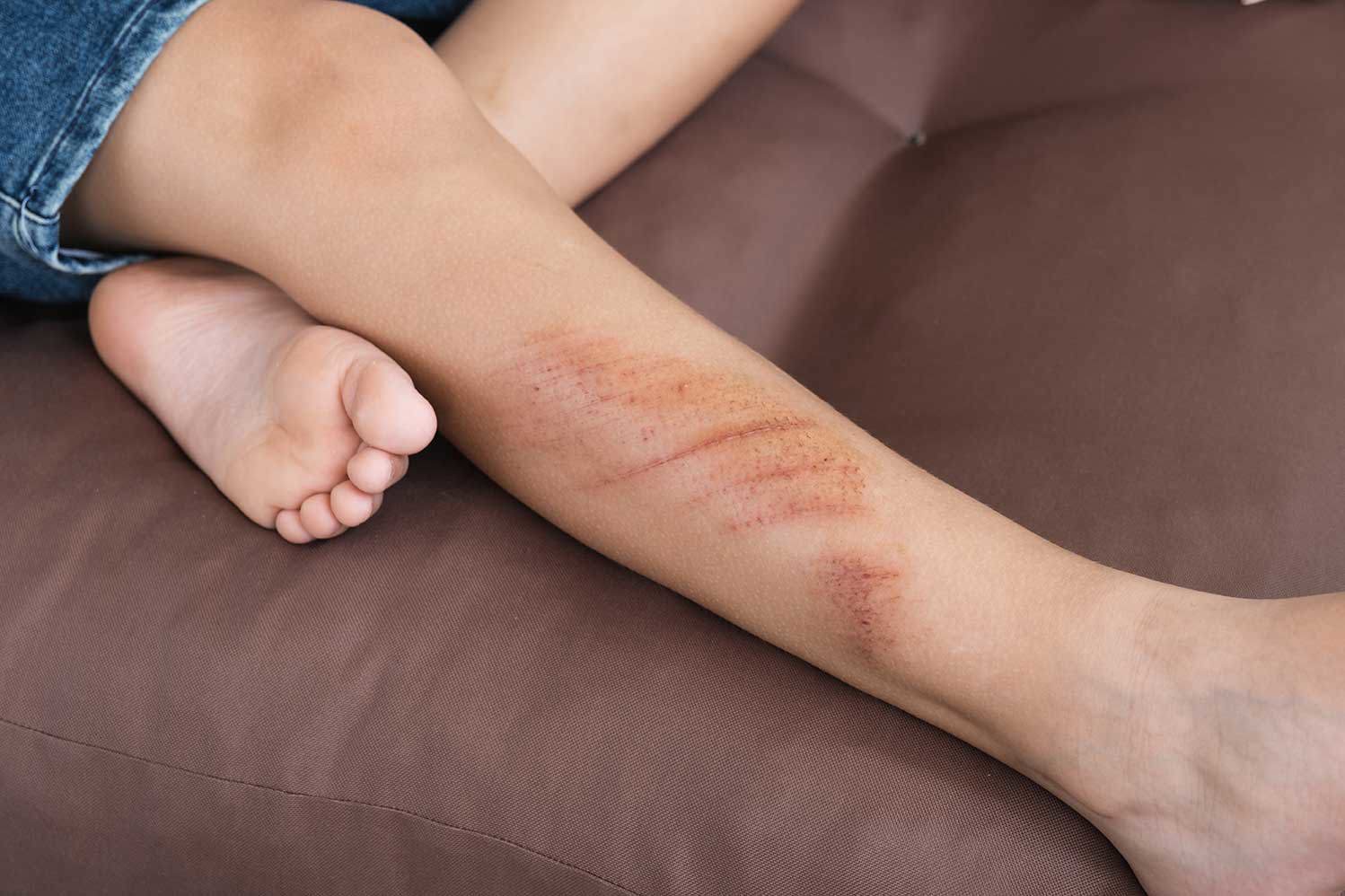 Nahaufnahme des Beins eines Kindes mit mehreren Kratzern und Abschürfungen, die verkrustete Wunden auf der Haut zeigen, wahrscheinlich von einer kürzlichen Verletzung. Das Kind sitzt, und der Fuß ist im Vordergrund sichtbar.