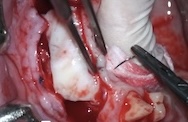 Connective tissue graft to improve peri-implant tissues in a patient with khoury-type bone graft