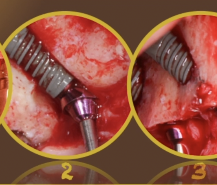 Manejo del desdentado total maxilar mediante el uso de implantes en arbotantes y técnicas de regeneración