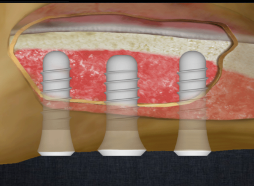 Manejo del sector posterior Maxilar